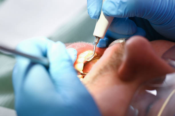 Best Emergency Gum Treatment in Harbour Heights, FL