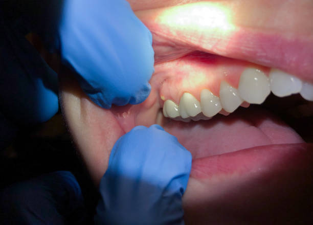 Best Emergency Dental Care for Broken or Chipped Teeth in Harbour Heights, FL