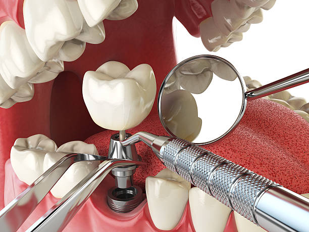 Best Emergency Treatment for Dental Infections or Abscesses in Harbour Heights, FL