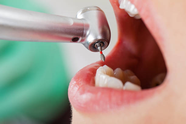 Best Emergency Dental Care for Broken or Chipped Teeth in Harbour Heights, FL